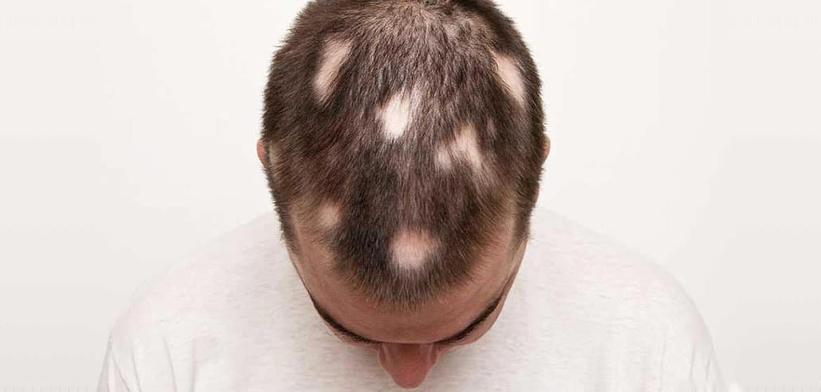 The Myths and Facts Behind FUE Hair Transplant